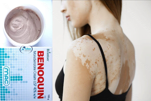 Original Benoquin For Vitiligo 0300-0378807 Buynow!